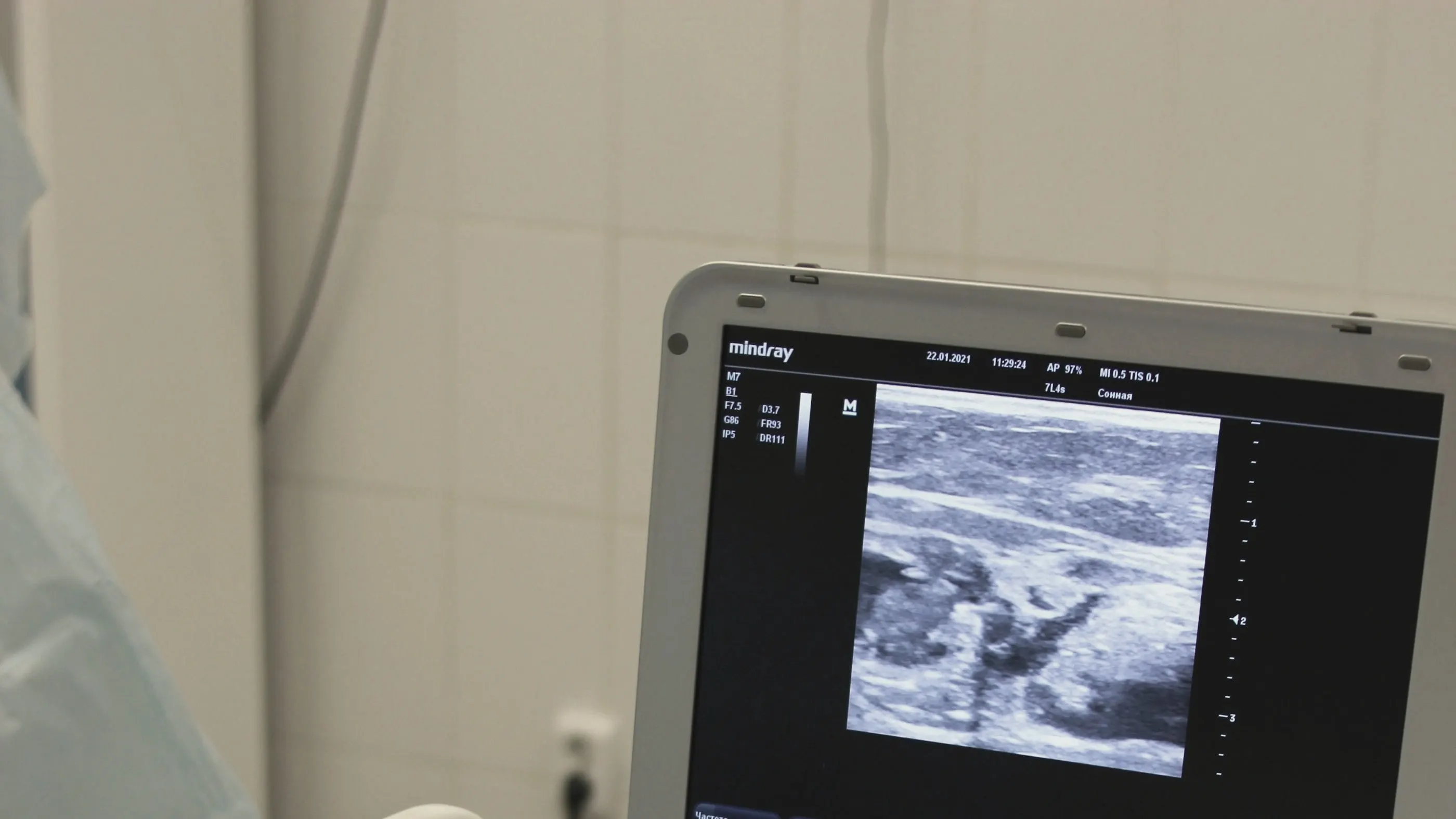 Monitor dell’ecografo con un esame in corso
