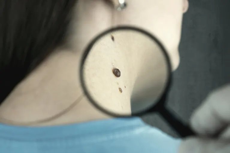 Controllo di un neo con la lente durante una visita dermatologica
