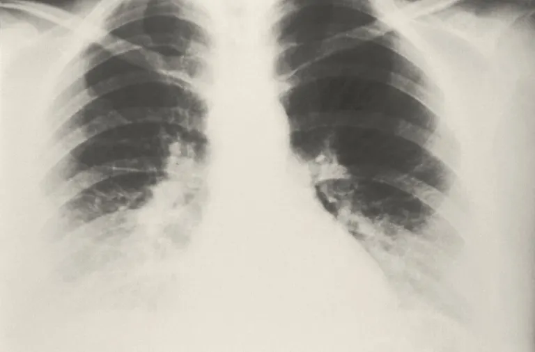 Radiografia del torace con i polmoni